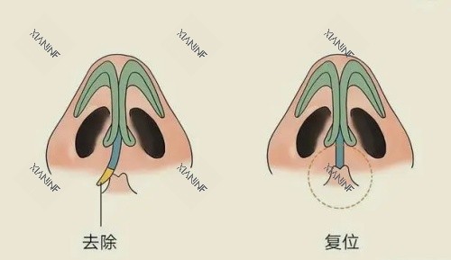 歪鼻修复矫正.jpg
