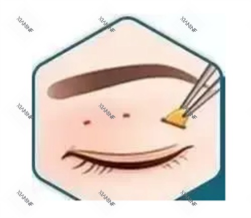 双眼皮三点术图.jpg