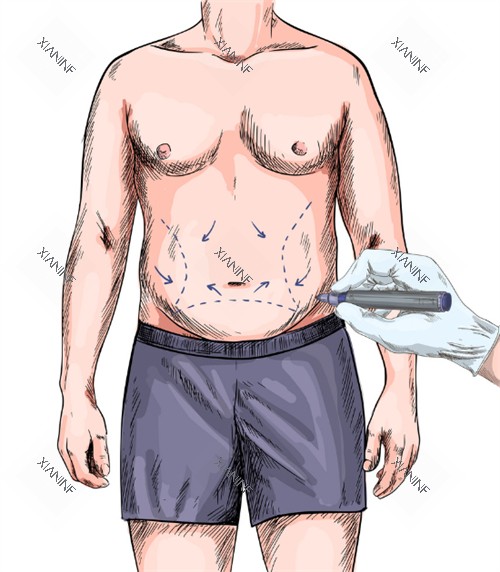 男生肚脐整形.jpg