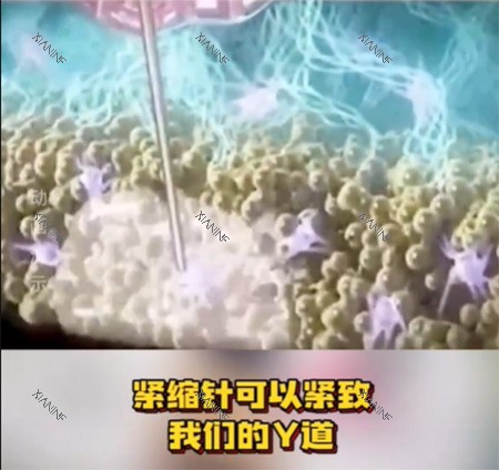 紧缩针怎么样.jpg
