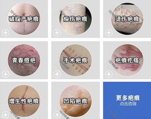 哪些疤痕需要祛除改善.jpg