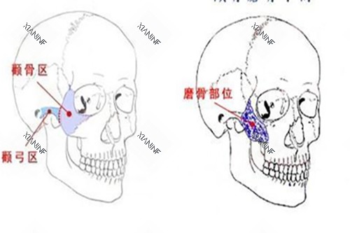 颧骨磨骨手术示意图.jpg