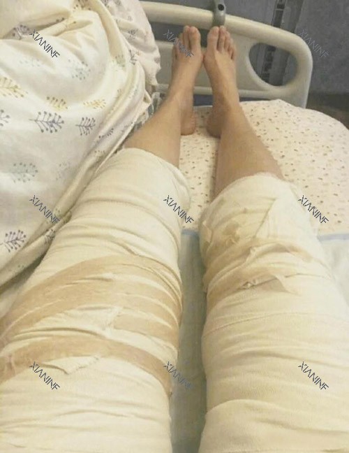 大腿吸脂照片.jpg 大腿吸脂照片.jpg