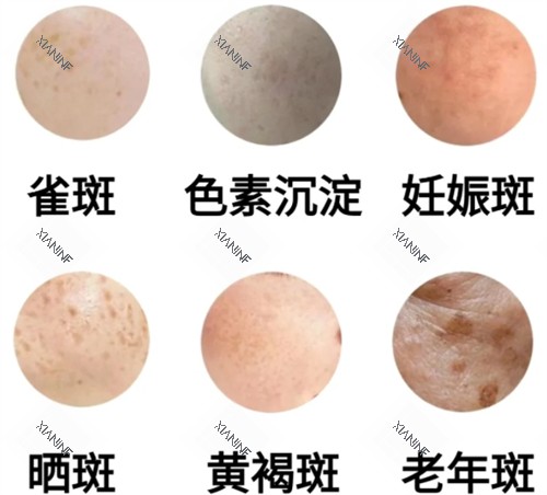 不同的皮肤斑点.jpg