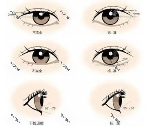 双眼皮对比图.JPG