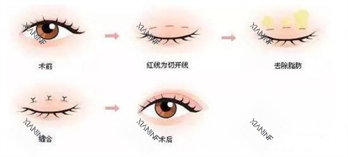 三点定位双眼皮手术过程.jpg 三点定位双眼皮手术过程.jpg
