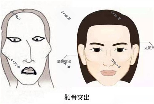 颧骨突出演示动画图.jpg 颧骨突出演示动画图.jpg