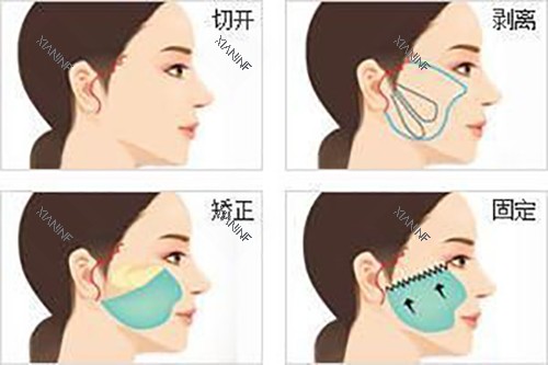 面部耳际小切口拉皮示意图.jpg