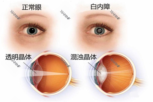 白内障与正常眼睛卡通对比图.jpg 白内障与正常眼睛卡通对比图.jpg