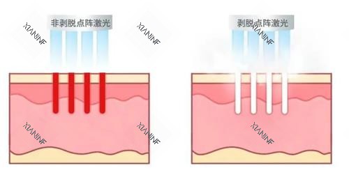不同类型的点阵激光.png 不同类型的点阵激光.png
