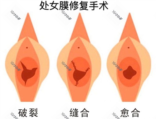 处女膜修复手术过程动画演示图.jpg 处女膜修复手术过程动画演示图.jpg