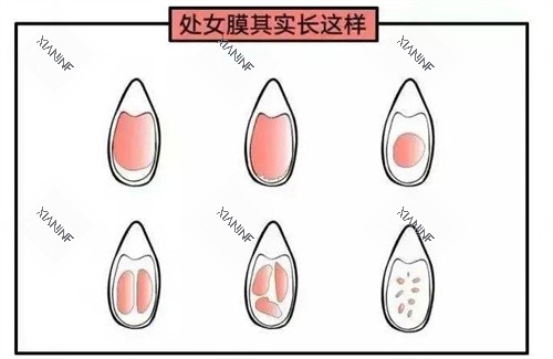 处女膜动画演示图.jpg 处女膜动画演示图.jpg