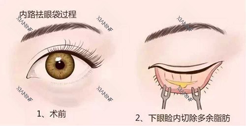 去眼袋手术.jpg 去眼袋手术.jpg