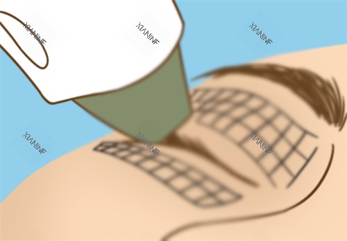 眼部热玛吉.jpg 眼部热玛吉.jpg