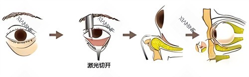 激光祛眼袋过程.jpg 激光祛眼袋过程.jpg