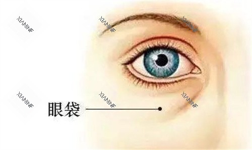 眼袋.jpg 眼袋.jpg
