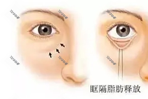 内切法眶隔脂肪释放.jpg 内切法眶隔脂肪释放.jpg