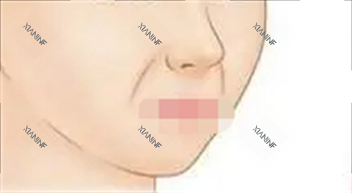 法令纹展示.png 法令纹展示.png