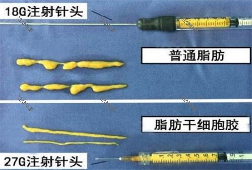自体脂肪填充需要的脂肪提纯后的样子图片.jpg 自体脂肪填充需要的脂肪提纯后的样子图片.jpg
