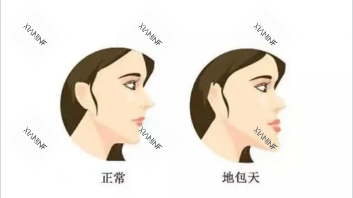 地包天示意图.png 地包天示意图.png