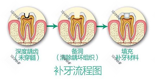 补牙流程.jpg