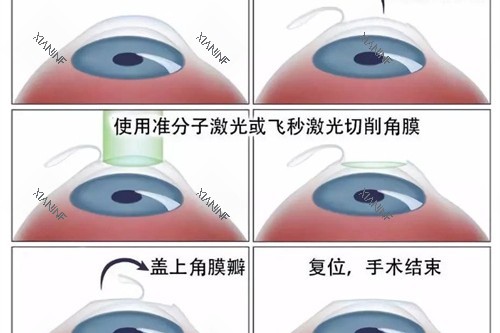 近视眼手术流程展示.jpg