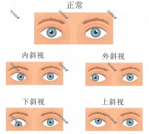 不同情况的斜视眼睛.jpg