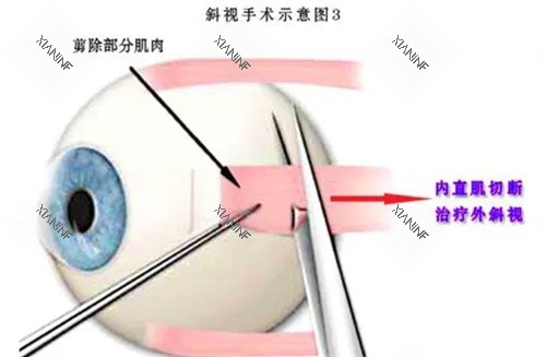 斜视手术示意图.jpg