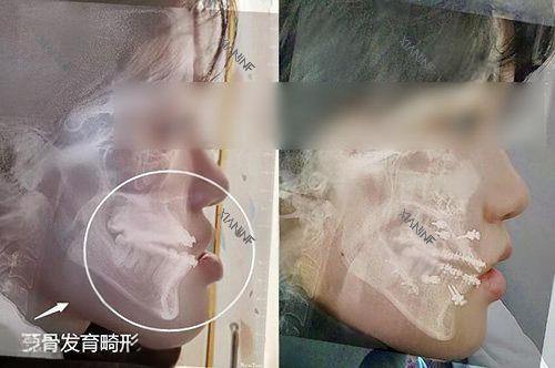 地包天正颌手术前后对比.jpg