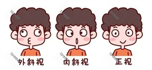 外斜内斜和正常眼睛的对比图.jpg