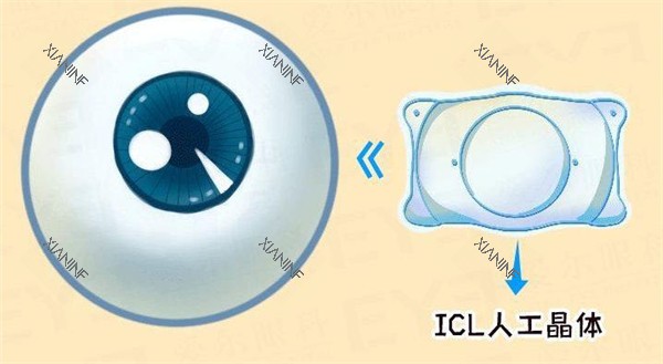 ICL人工晶体图示.jpg