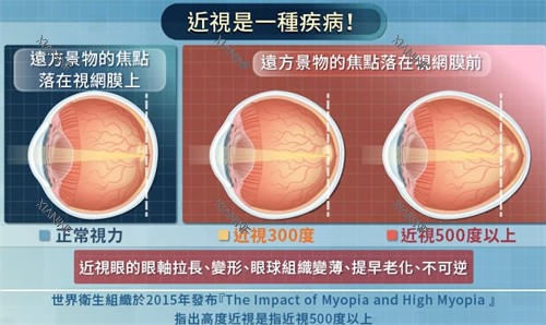 不同程度近视的眼球变化图解.jpg