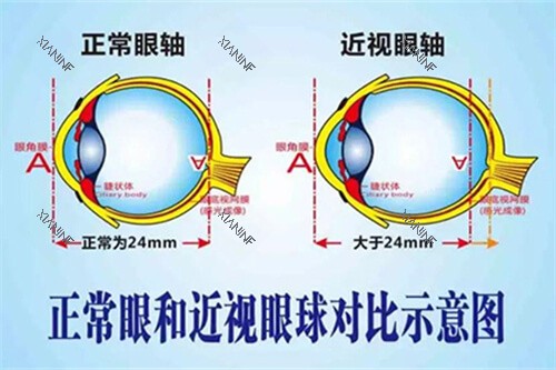 正常眼和近视眼球对比示意图.jpg
