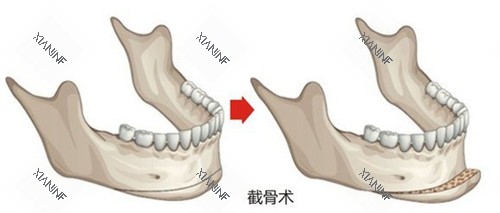 vline手术前后变化.jpg