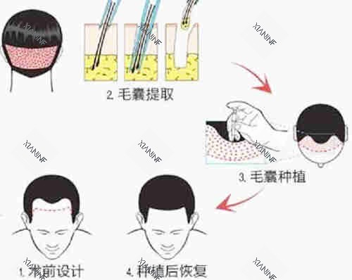 植发过程图解详细.jpg