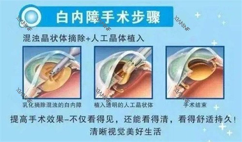 白内障手术示意图.jpg