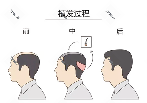 植发过程图示.png