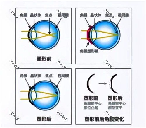 角膜塑形镜佩戴后角膜变化.jpg