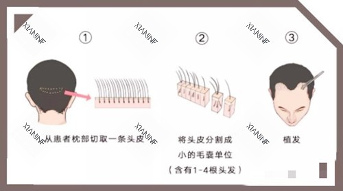 头发移植图示.jpg
