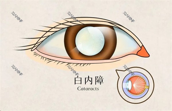 白内障怎么办.jpg