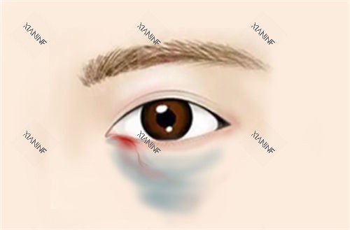 眼下出血发青动画展示图.jpg