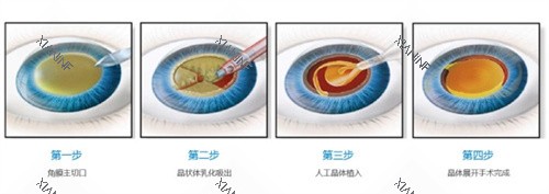 白内障手术过程.jpg