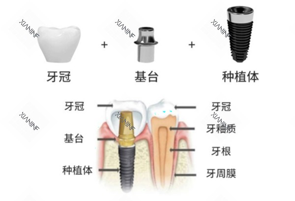 威高种植牙手术过程示意图.jpg