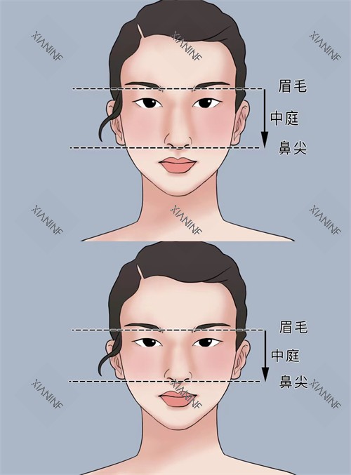 正常鼻子和过长鼻子矫正对比.jpg