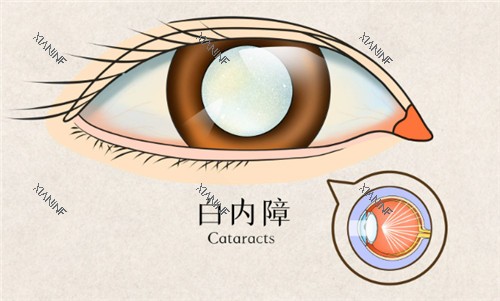 白内障眼睛表现.jpg