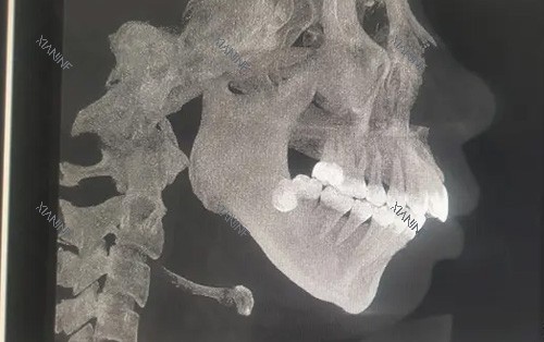需要做正颌手术的骨骼图.jpg