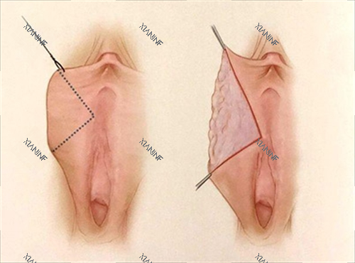 女性私密手术动画展示.png