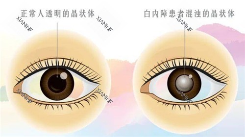 白内障和正常眼球的对比图.jpg