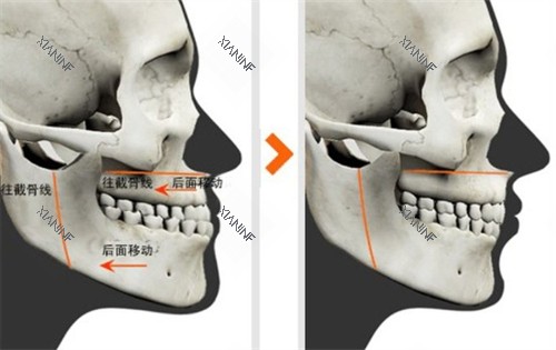 双鄂手术对比图.jpg