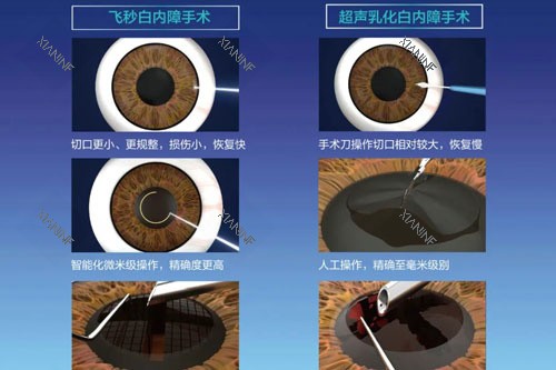 飞秒白内障和超声乳化白内障.jpg